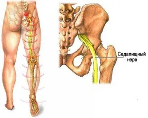 sciatic