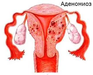 Tratamentul adenomiozei uterine, simptome, semne