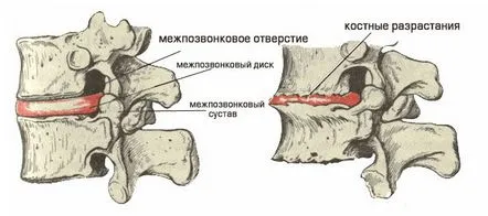 osteocondroza