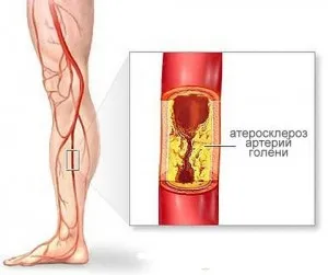 Ateroscleroza vaselor extremităților inferioare