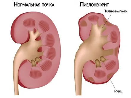 Simptomele și tratamentul pielonefritei la femei