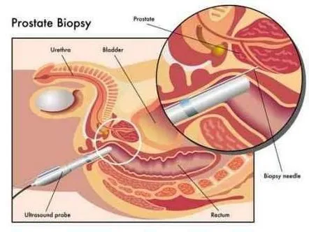 Caracteristici ale pregătirii și conducerii biopsiei de prostată, prețuri și recenzii despre procedură