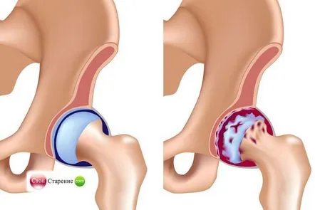 Coxartroza articulației șoldului metode de tratament