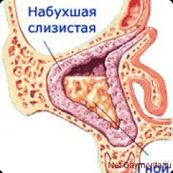 Simptomele sinuzitei odontogene și complicațiile bolii