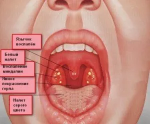 Cum să tratezi rapid și ieftin angina pectorală acasă