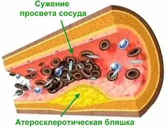 Ateroscleroza, cauzele, simptomele și tratamentul acesteia