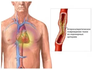 Ce este angioplastia cu balon cu stenting