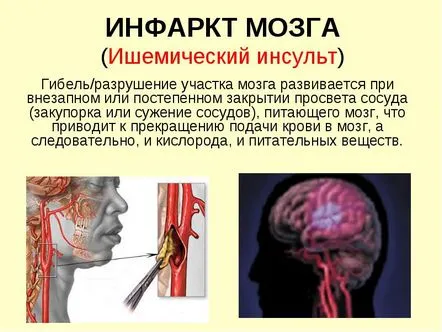 Consecințele infarctului cerebral. Riscuri de care pacientul ar trebui să fie conștient.