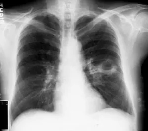 pulmonar