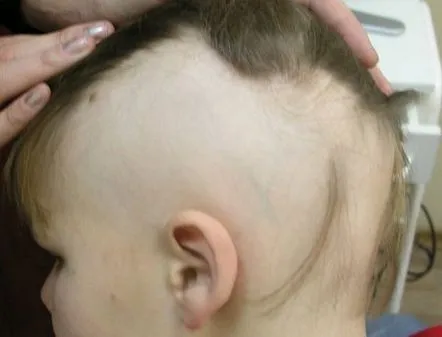 Alopecia la copii