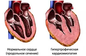 Cardiomiopatie hipertrofică, simptome ale bolii și principii de tratament