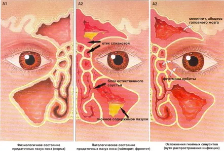 Semne caracteristice ale sfenoiditei. Opțiuni de tratament pentru procesul acut și cronic