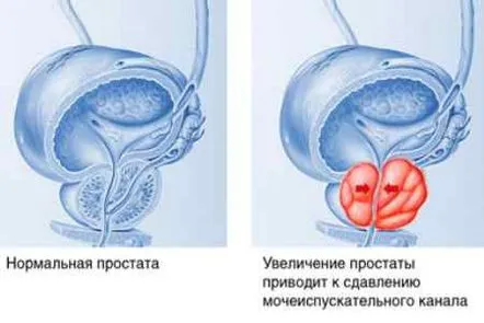 Tratament cu masaj, cât de eficientă este această metodă pentru prostatită