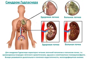 Sindromul Goodpascher, simptomele și tratamentul patologiei