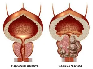 Adenom de prostată