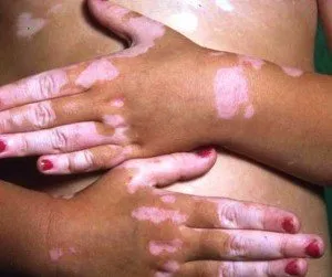 Tratamentul bolii periculoase de piele Vitiligo cu remedii populare