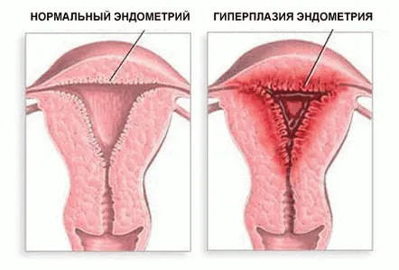 Care este pericolul hiperplaziei endometriale