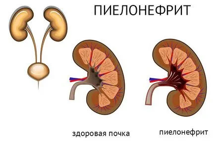 Pielonefrita la copii cauze, simptome, diagnostic și tratament