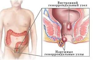 Tromboza nodului hemoroidal, etiologia și metodele de terapie