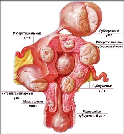 Ce este miomul uterin periculos Subseros, nodular și interstițial.