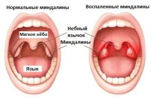 Forme contagioase sau purulente și simple de angină pectorală