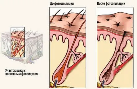 Cât durează fotoepilarea și cum se face?