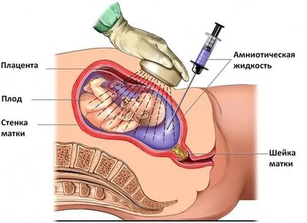 Amniocenteza de facut sau nu, ce patologii sunt depistate, posibile consecinte