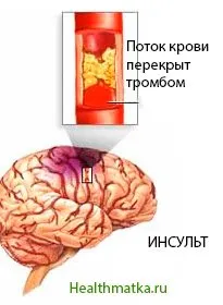 Cauzele accidentului vascular cerebral și măduva spinării, metode de tratament