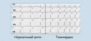 tahicardie