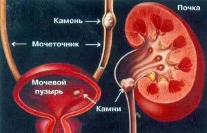 Timpul pentru a colecta pietre pentru tratamentul urolitiazelor