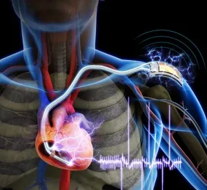 Oamenii de știință britanici folosesc stimulatoare cardiace