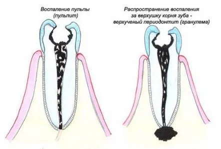 granulomului