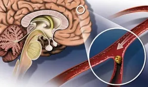 Chistul pineal al creierului cauze, simptome, tratament