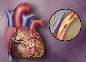 Cardioscleroza aterosclerotică, tabloul clinic al bolii și principiile de tratament