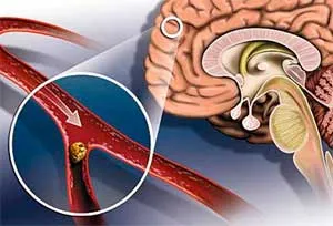 Accident vascular cerebral, istoricul medical al unei fete