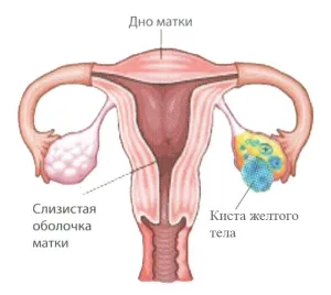 Chistul corpului galben al ovarului