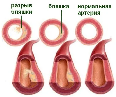 Colesterolul. Ateroscleroza. Îmbătrânire.