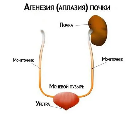 Ageneza (aplazia) rinichilor cauze, simptome și tratament