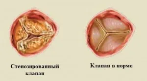 Simptome și principii caracteristice astmului cardiac