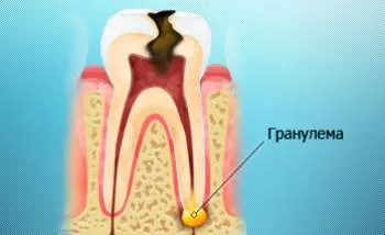 Cauzele și tratamentul granulomului pe rădăcina unui dinte