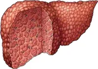 Ce este ciroza hepatică decompensată și câți locuiesc cu el