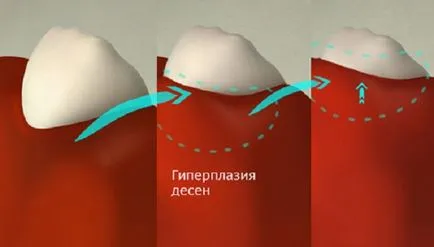 Какво е дъвка фиброматоза, се третира като болест