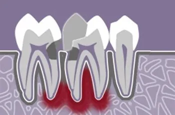 Tratamentul parodontitei fibroase cronice