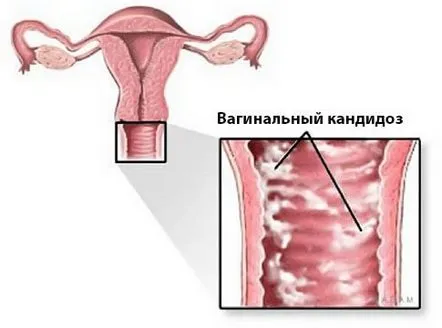 Cauzele, simptomele și tratamentul candidozei vaginale