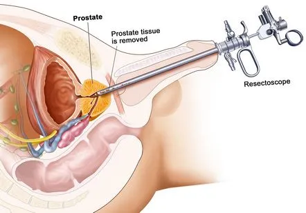 Ce este prostata