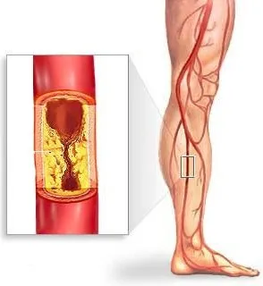 Simptomele și tratamentul aterosclerozei extremităților inferioare