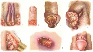 Simptome ușoare de șancru și tratament pentru femei și bărbați