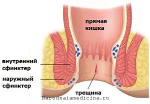 Fisura anala