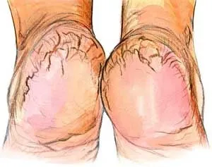 Tratamentul fisurilor și umflăturilor pe călcâie cu remedii populare