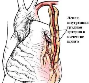 Chirurgia bypass aortocoronarian în Israel informații generale despre operații